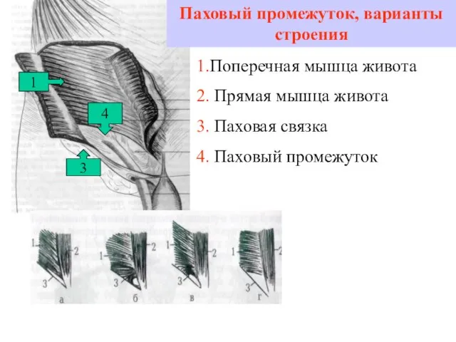 Паховый промежуток, варианты строения 1 3 1.Поперечная мышца живота 2. Прямая мышца