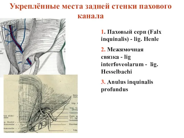 Укреплённые места задней стенки пахового канала 1. Паховый серп (Falx inquinalis) -