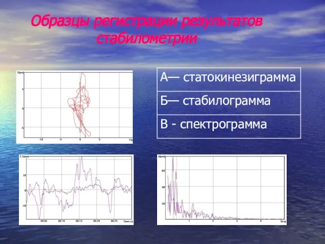 Образцы регистрации результатов стабилометрии