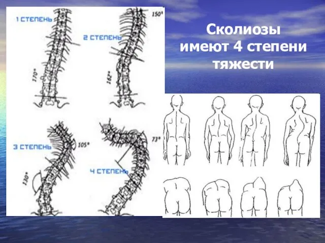 Сколиозы имеют 4 степени тяжести