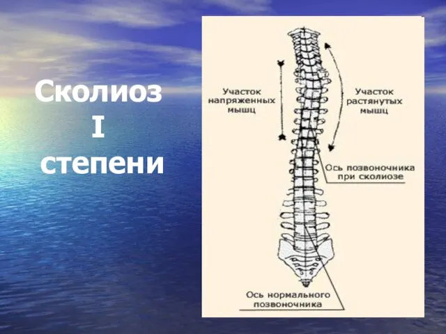 Сколиоз I степени