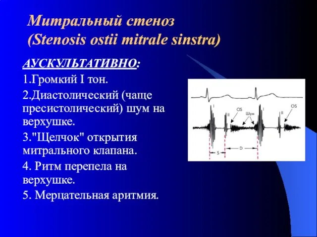 Митральный стеноз (Stenosis ostii mitrale sinstra) АУСКУЛЬТАТИВНО: 1.Громкий I тон. 2.Диастолический (чаще