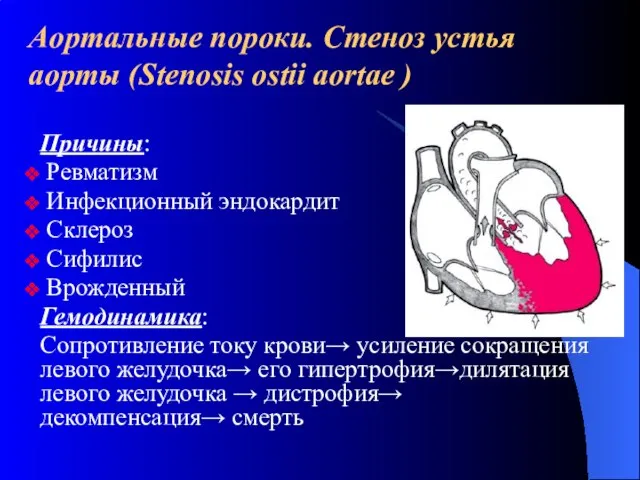 Аортальные пороки. Стеноз устья аорты (Stenosis ostii aortae ) Причины: Ревматизм Инфекционный