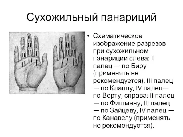 Сухожильный панариций Схематическое изображение разрезов при сухожильном панариции слева: II палец —