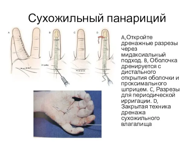 Сухожильный панариций A,Откройте дренажные разрезы через мидаксиальный подход. B, Оболочка дренируется с