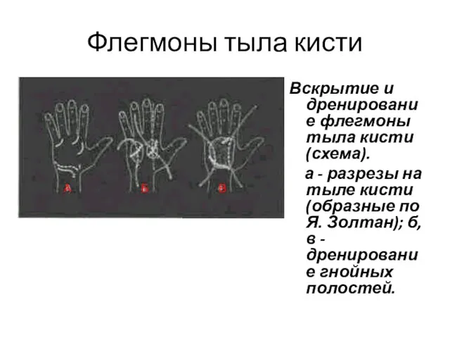 Флегмоны тыла кисти Вскрытие и дренирование флегмоны тыла кисти (схема). а -