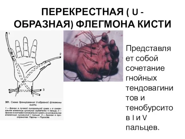 ПЕРЕКРЕСТНАЯ ( U -ОБРАЗНАЯ) ФЛЕГМОНА КИСТИ Представляет собой сочетание гнойных тендовагинитов и