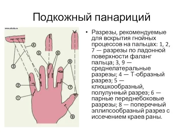 Подкожный панариций Разрезы, рекомендуемые для вскрытия гнойных процессов на пальцах: 1, 2,