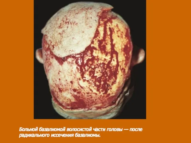 Больной базалиомой волосистой части головы — после радикального иссечения базалиомы.