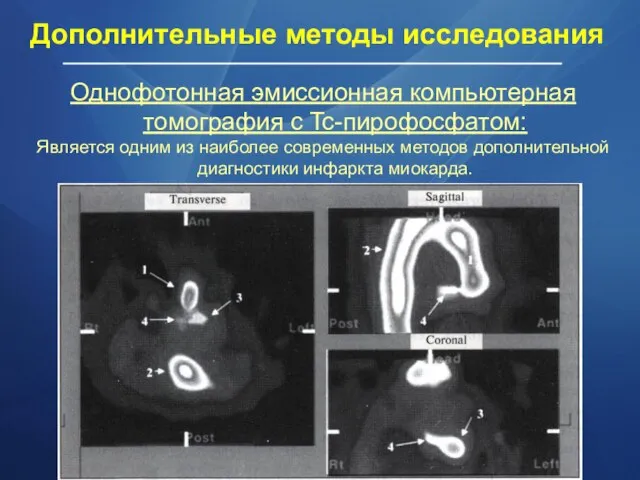 Однофотонная эмиссионная компьютерная томография с Tc-пирофосфатом: Является одним из наиболее современных методов