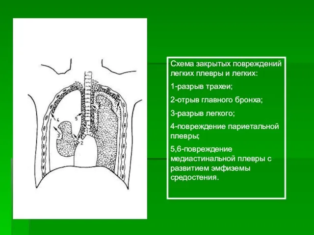 Схема закрытых повреждений легких плевры и легких: 1-разрыв трахеи; 2-отрыв главного бронха;