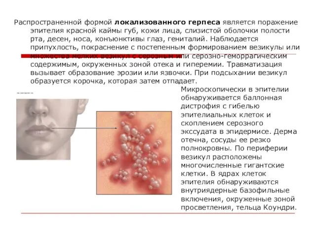 Распространенной формой локализованного герпеса является поражение эпителия красной каймы губ, кожи лица,