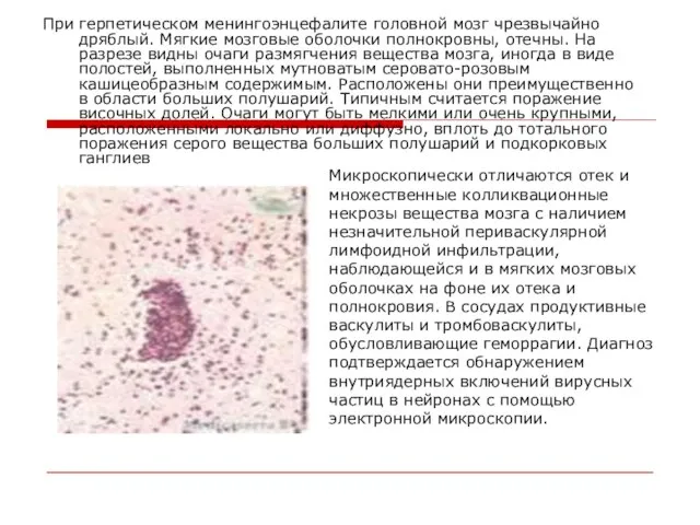 При герпетическом менингоэнцефалите головной мозг чрезвычайно дряблый. Мягкие мозговые оболочки полнокровны, отечны.