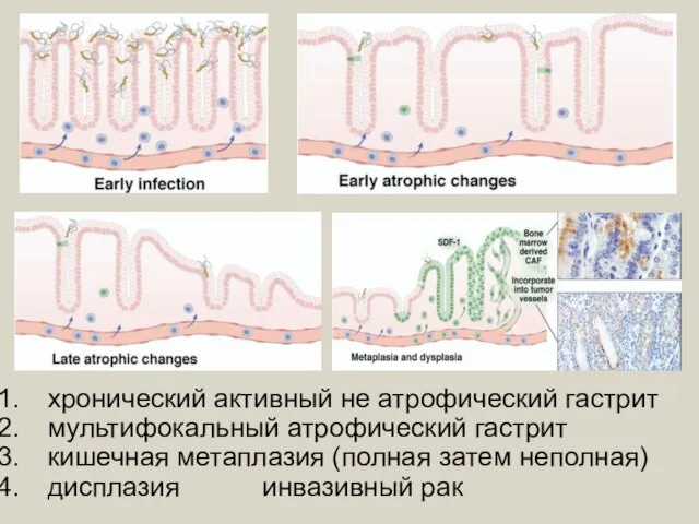 хронический активный не атрофический гастрит мультифокальный атрофический гастрит кишечная метаплазия (полная затем неполная) дисплазия инвазивный рак