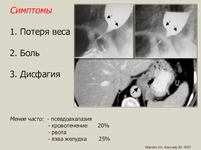 Симптомы 1. Потеря веса 2. Боль 3. Дисфагия Менее часто: - псевдоахалазия