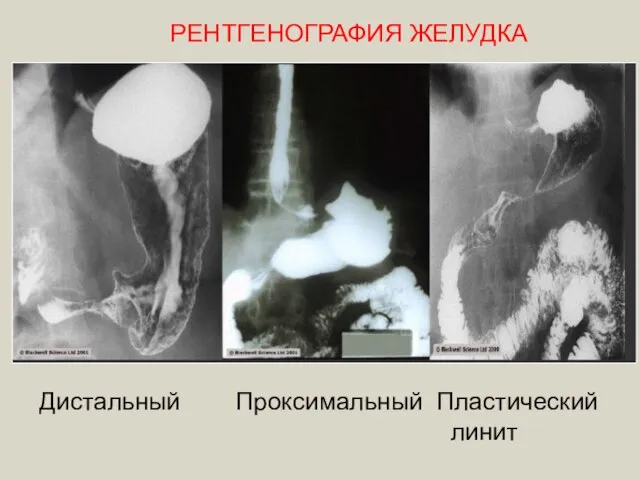 Дистальный Проксимальный Пластический линит РЕНТГЕНОГРАФИЯ ЖЕЛУДКА