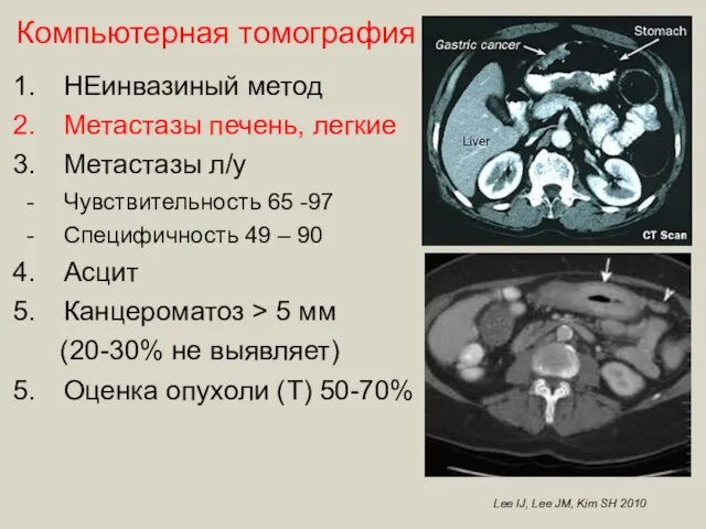 Lee IJ, Lee JM, Kim SH 2010 Компьютерная томография НЕинвазиный метод Метастазы