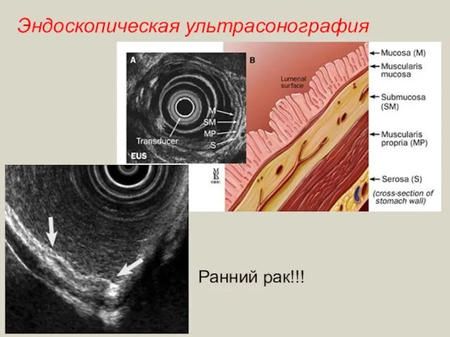 Эндоскопическая ультрасонография Ранний рак!!!