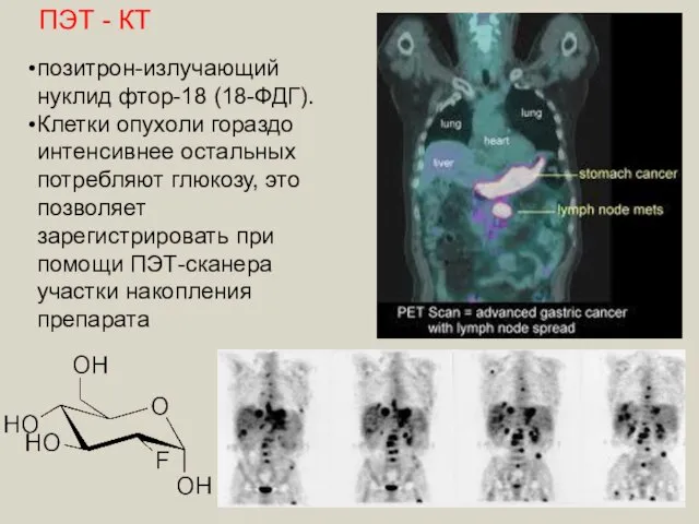 ПЭТ - КТ позитрон-излучающий нуклид фтор-18 (18-ФДГ). Клетки опухоли гораздо интенсивнее остальных