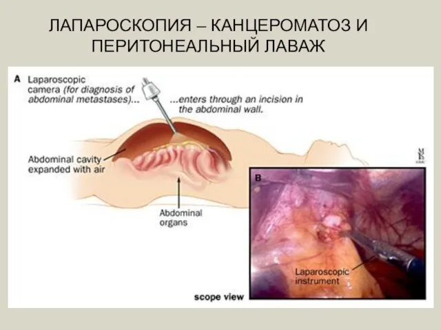 ЛАПАРОСКОПИЯ – КАНЦЕРОМАТОЗ И ПЕРИТОНЕАЛЬНЫЙ ЛАВАЖ