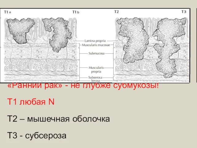 «Ранний рак» - не глубже субмукозы! Т1 любая N Т2 – мышечная оболочка Т3 - субсероза