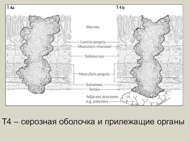 Т4 – серозная оболочка и прилежащие органы