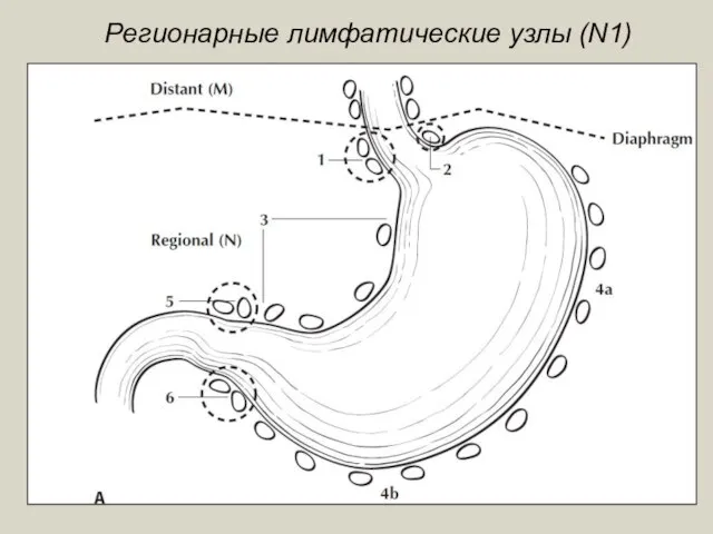 Регионарные лимфатические узлы (N1)