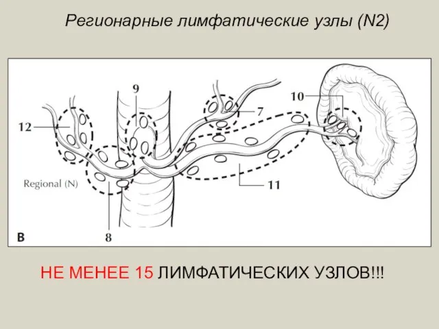 Регионарные лимфатические узлы (N2) НЕ МЕНЕЕ 15 ЛИМФАТИЧЕСКИХ УЗЛОВ!!!