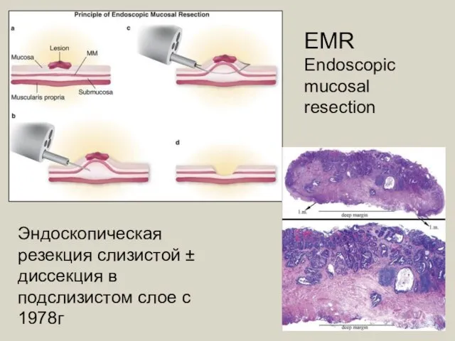 EMR Endoscopic mucosal resection Эндоскопическая резекция слизистой ± диссекция в подслизистом слое с 1978г