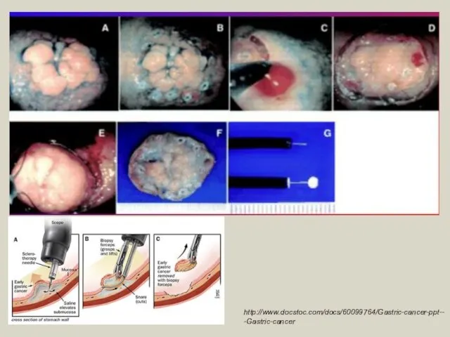 http://www.docstoc.com/docs/60099764/Gastric-cancer-ppt---Gastric-cancer