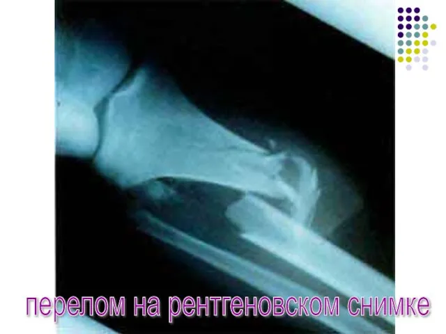 перелом на рентгеновском снимке