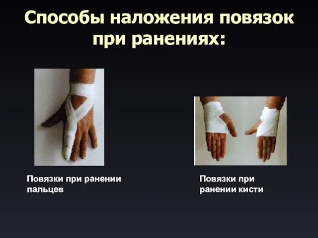 Способы наложения повязок при ранениях: Повязки при ранении пальцев Повязки при ранении кисти