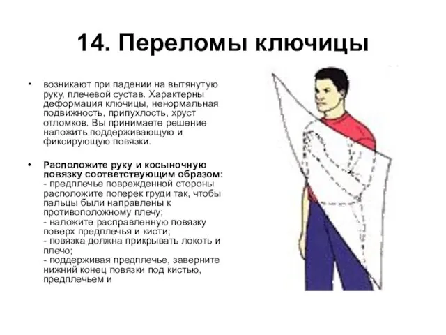 14. Переломы ключицы возникают при падении на вытянутую руку, плечевой сустав. Характерны