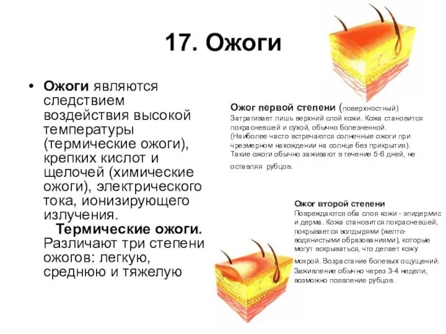 17. Ожоги Ожоги являются следствием воздействия высокой температуры (термические ожоги), крепких кислот