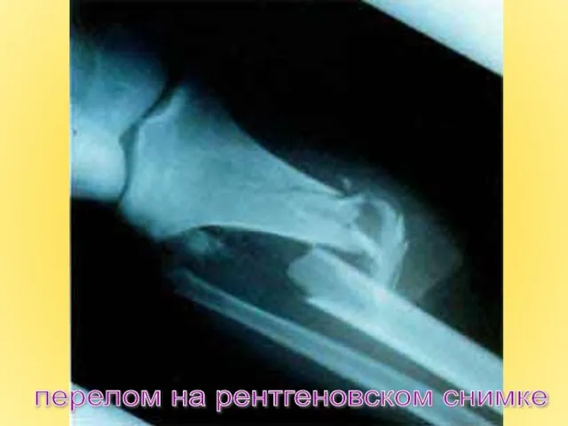 перелом на рентгеновском снимке