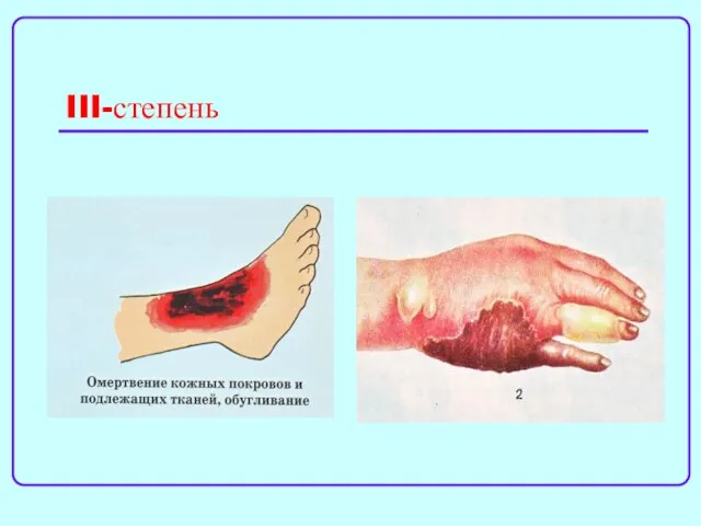 III-степень