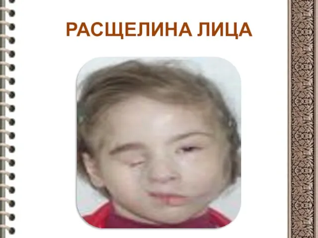 РАСЩЕЛИНА ЛИЦА