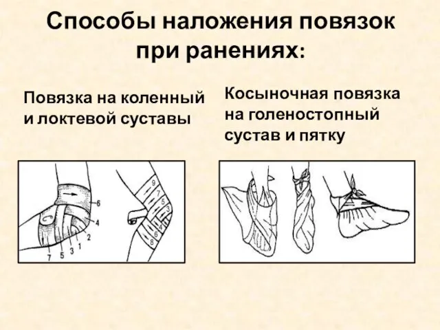 Способы наложения повязок при ранениях: Повязка на коленный и локтевой суставы Косыночная