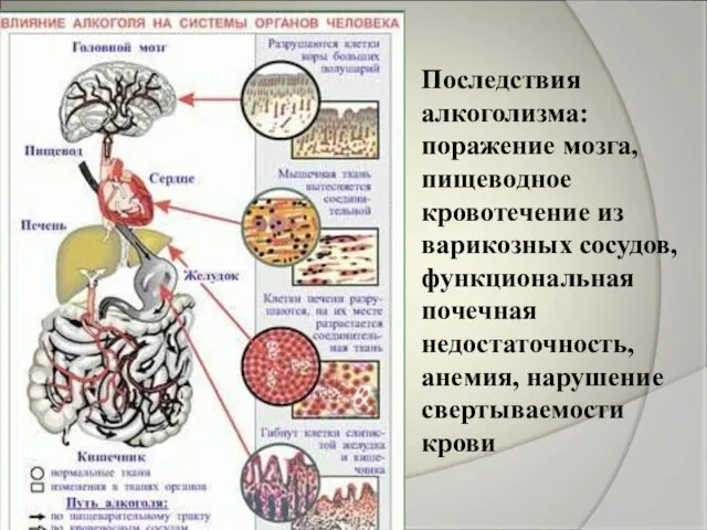 Последствия алкоголизма: поражение мозга, пищеводное кровотечение из варикозных сосудов, функциональная почечная недостаточность, анемия, нарушение свертываемости крови