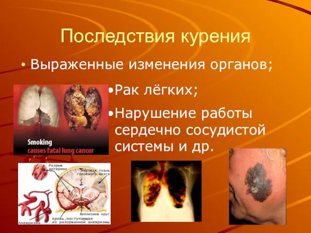 Последствия курения Выраженные изменения органов; Рак лёгких; Нарушение работы сердечно сосудистой системы и др.