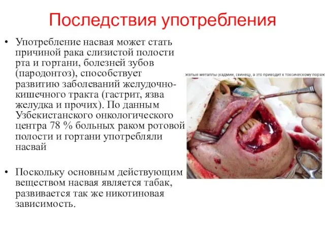 Последствия употребления Употребление насвая может стать причиной рака слизистой полости рта и