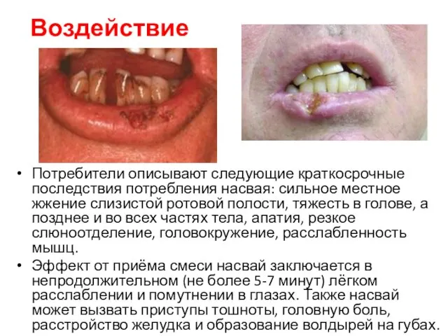 Воздействие Потребители описывают следующие краткосрочные последствия потребления насвая: сильное местное жжение слизистой