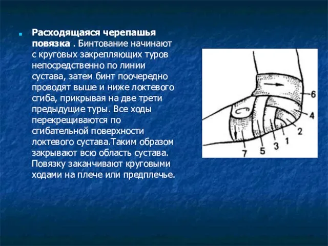 Расходящаяся черепашья повязка . Бинтование начинают с круговых закрепляющих туров непосредственно по