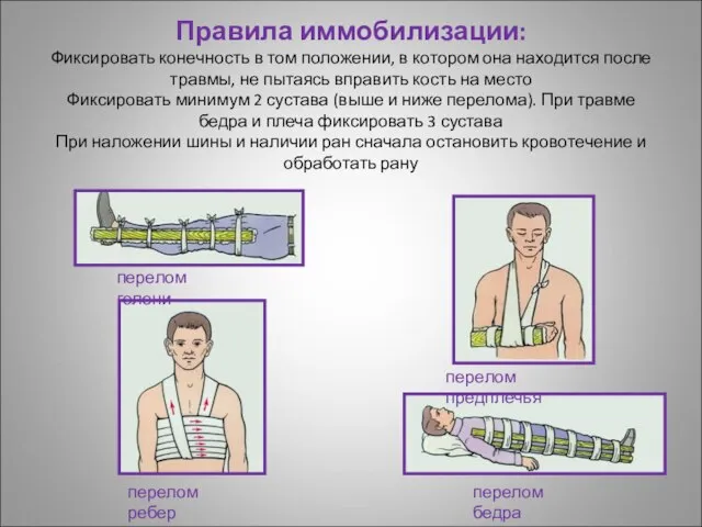 Правила иммобилизации: Фиксировать конечность в том положении, в котором она находится после