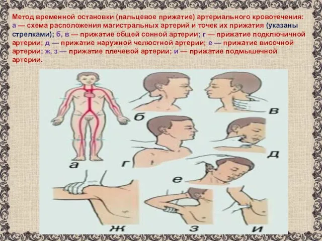 Метод временной остановки (пальцевое прижатие) артериального кровотечения: а — схема расположения магистральных