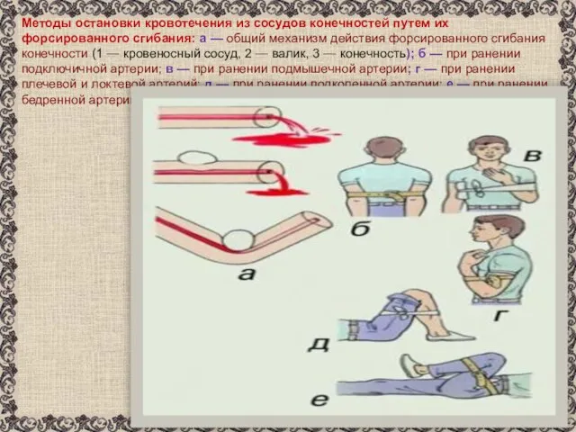 Методы остановки кровотечения из сосудов конечностей путем их форсированного сгибания: а —