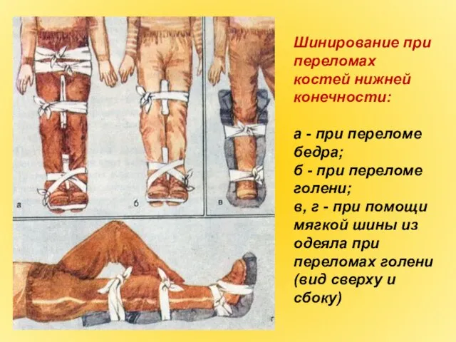 Шинирование при переломах костей нижней конечности: а - при переломе бедра; б