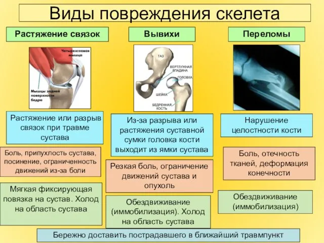 Виды повреждения скелета Растяжение связок Вывихи Переломы Боль, отечность тканей, деформация конечности