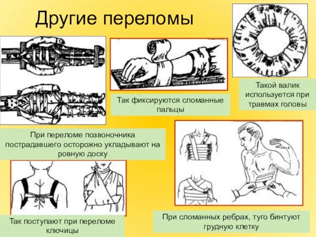 Другие переломы Такой валик используется при травмах головы Так фиксируются сломанные пальцы