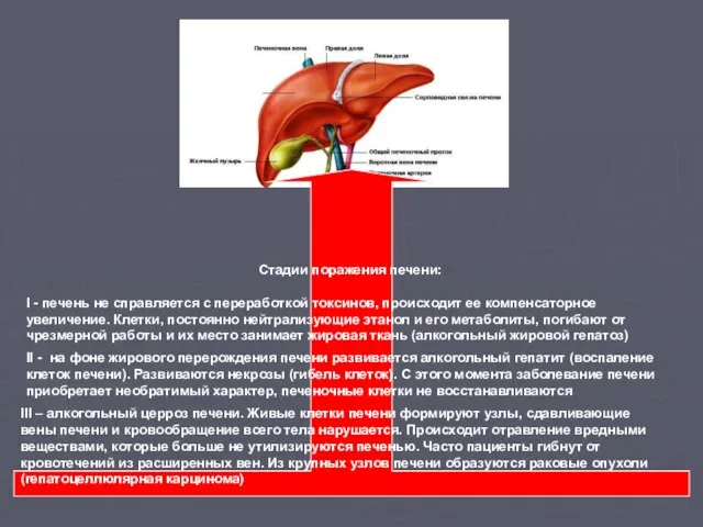 Стадии поражения печени: I - печень не справляется с переработкой токсинов, происходит